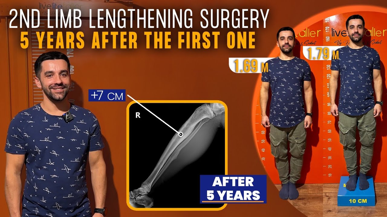 FIVE YEARS AFTER THE FIRST LIMB LENGTHENING SURGERY, HE DECIDED TO DO A SECOND SURGERY