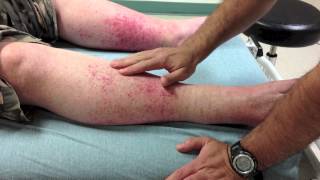 vasculitis