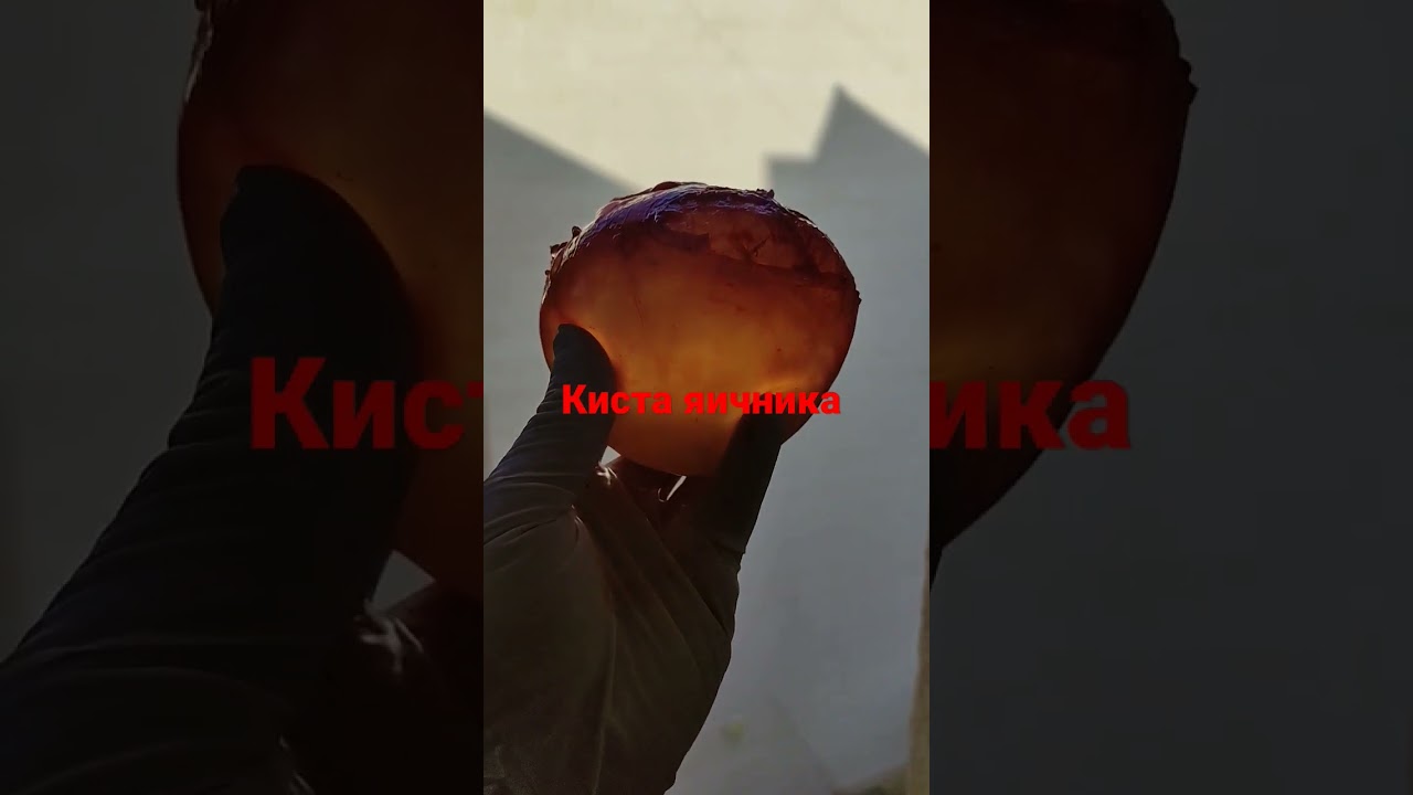 киста яичника