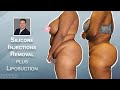 Removal Of 10 Year Old Silicone Injections Plus Cosmetic Liposuction