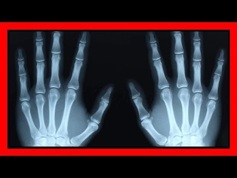 Se malati tutte le articolazioni osteocondrosi Un medico curante periartrite di spalla