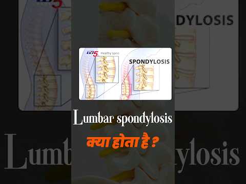 What is Lumbar Spondylosis & it's symptoms ? | Lumbar Spondylosis | #lumbarspondylosis  #helthtips