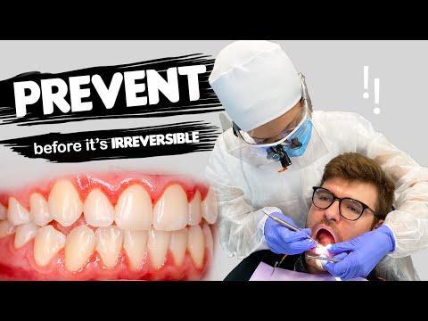 How To Prevent Gum Disease & What Causes Gum Disease