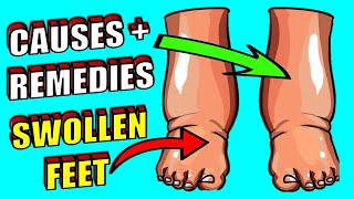 SWOLLEN FEET - Cause & Home Remedies For Swollen Feet
