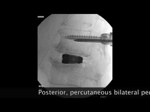 Lussazione congenita dellarticolazione dellanca si può partorire Individuazione e mal di schiena