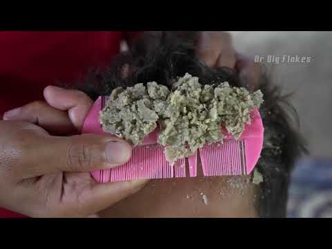 Dandruff Scratching Crazy Flakes!! | Dry Itchy Scalp Natural Dandruff Huge Flake #185