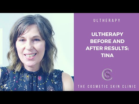 Tina on Ultherapy®