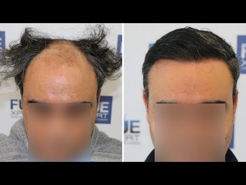 FUE Hair Transplant (3500 Grafts in NW V) Dr. Juan...