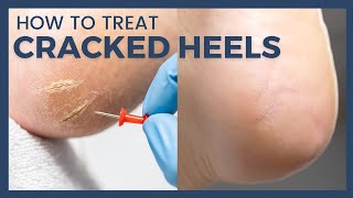 How To Treat Cracked Heels - Reduce Callus and Fissures