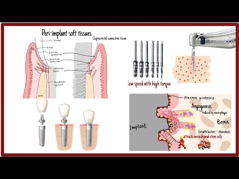 Dental Implants | How an implant attaches to bone | Osseointegration of dental implants
