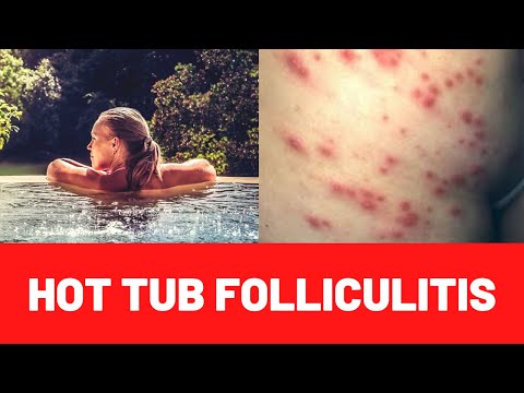 HOT TUB RASH (FOLLICULITIS) : Symptoms-Causes-Treatment-Cure-Infection-Pseudomonas Aeruginosa