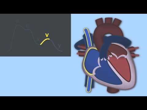 Interpreting Central Venous Pressure Waveforms by J. DiNardo | OPENPediatrics
