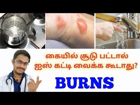 , title : 'Emergency 04 || தீக்காயம் முதலுதவி || How to avoid scar ||Burns -Do's & Don'ts || Dr MOHANAVEL_Tamil'
