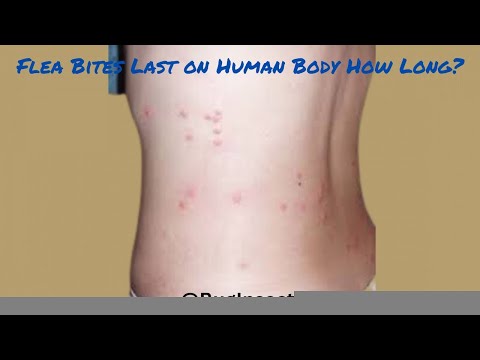 How Long Do Flea Bites Last on Human Body