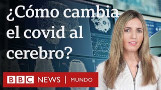 Cómo cambia el cerebro tras una infección por coronavirus, aunque esta sea leve | BBC Mundo