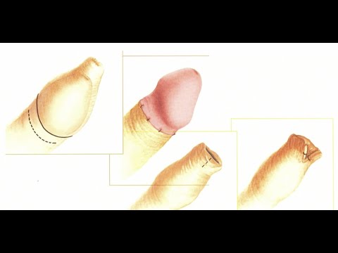 Comment guérir une courbure du pénis