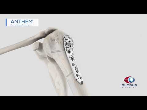 ANTHEM Proximal Humerus Surgical Animation