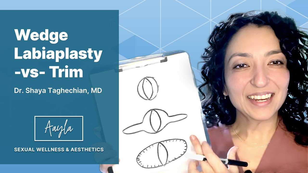Wedge Labiaplasty vs. Trim Labiaplasty