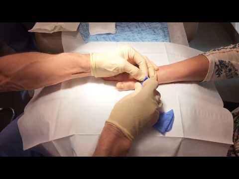 Kung paano sa pagalingin halamang-singaw ay ang hinlalaki sa paa Isang doktor pagpapagamot ng halamang-singaw sa kanyang mga paa