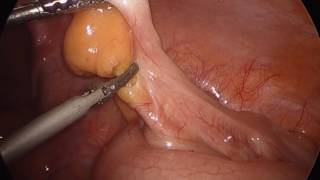 Laparoscopic appendectomy Laparoscopic appendectomy