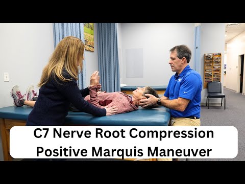 Positive Hoffman s Sign Hyperreflexia and Spurling s Test