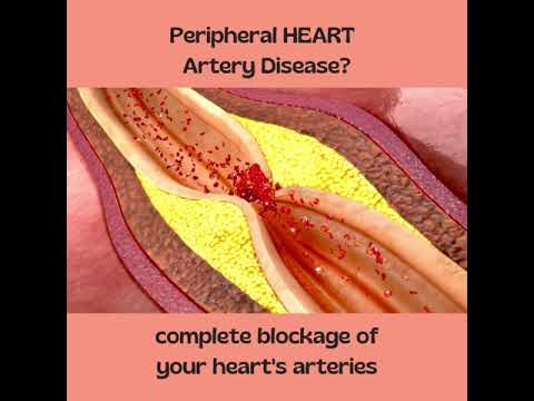 Complete Heart Blockage - Symptoms of Heart Attack