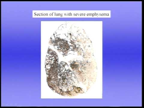 Pulmonary Gas Exchange-Part II