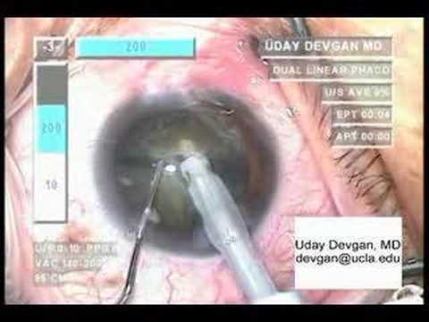 Horizontal Chop Technique In Cataract Surgery