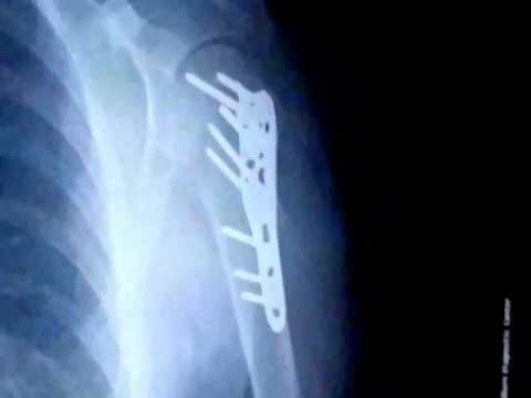 Adrenal Fatigue Is Cortisol Responsible for Your Diabetes Dr Berg