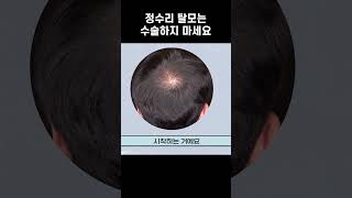 탈모용 PRP 성형 시술