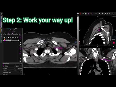 Brachial Plexus Contouring