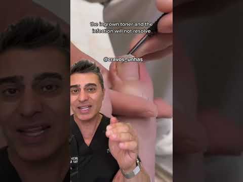 Ingrown Toenail Treatment! What is it? Foot Doctor Breaks it down