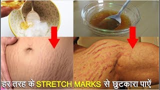स्ट्रेच मार्क्स को तेजी से कम करने के सबसे असरदार घरेलु नुस्खे | Stretch Marks removal at home