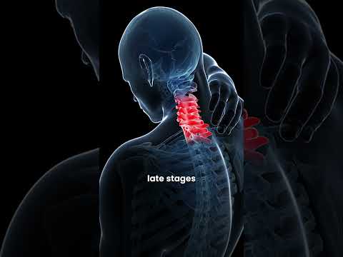 What Is Tech Neck Syndrome? Causes, Symptoms & Prevention | Dr. Ajay Kothari