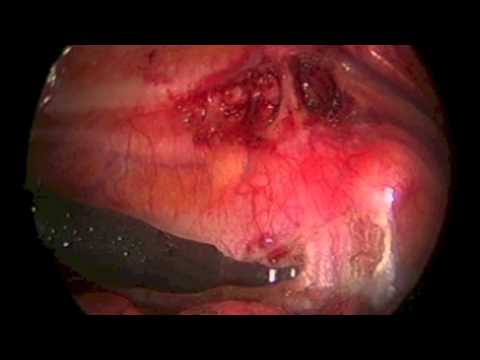 Thoracoscopic Sympathectomy