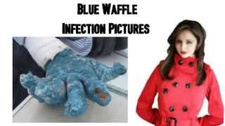 Blue Waffle Infection Pictures