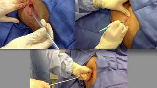 Chest Tube Placement