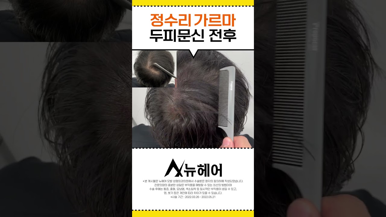 머리숱이 더 많아 보이는 두피문신! 이런 머리라면 하세요!