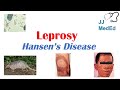 Leprosy (Hansen's disease) | Who is at risk, Signs and Symptoms, Diagnosis, and Treatment