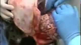 Medical Videos Human Autopsy Anatomy
