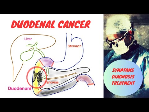 Zwölffingerdarmkrebs
