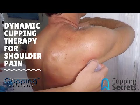 Dynamic Cupping Therapy for Shoulder Pain * Silicone Cups* Tendonitis, Rotator Cuff, Frozen Shoulder