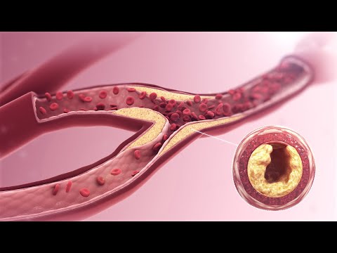 High Triglycerides and Fatty Liver: 7 Steps to Solve