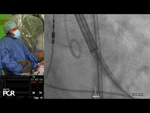 Innovation and strategies in TAVI: design, data and directions for clinical practice  - EuroPCR 2024