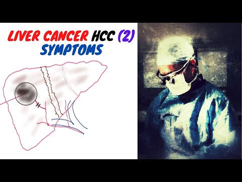 LIVER CANCER (HCC); Symptoms (2)