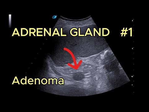 Adrenal adenoma video preview
