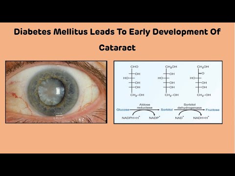 Why Diabetes Mellitus Leads To Early Development Of Cataract || Diabetes And Cataract