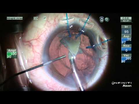 Traumatic Cataract Extraction: Keep The Bag? Or Not?