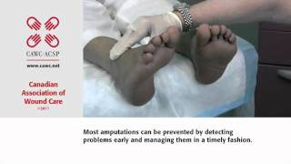 Canadian Association of Wound Care Foot Care Video. Diabetes, Healthy Feet and You.