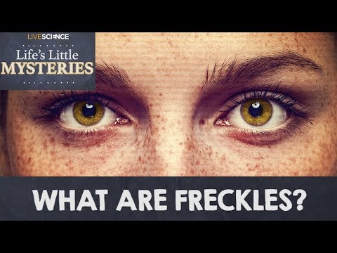 What are Freckles?